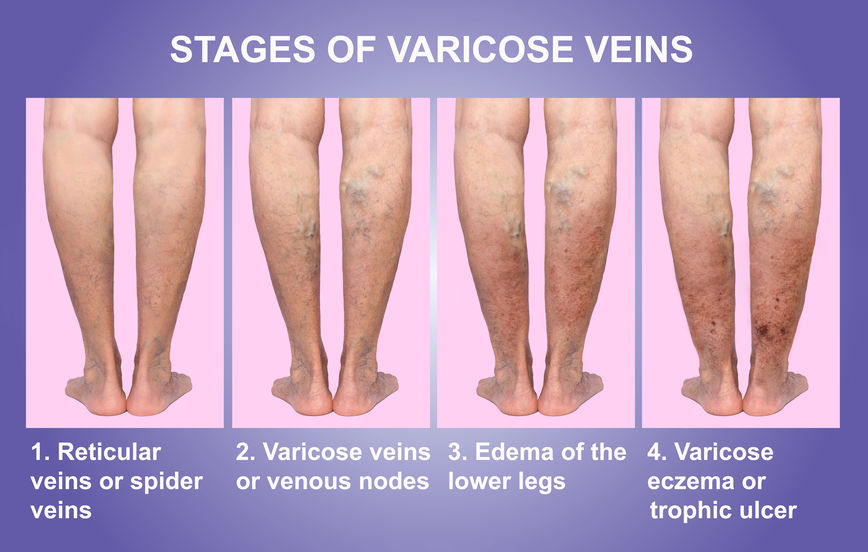 What Is the Difference between Varicose Veins and Spider Veins?