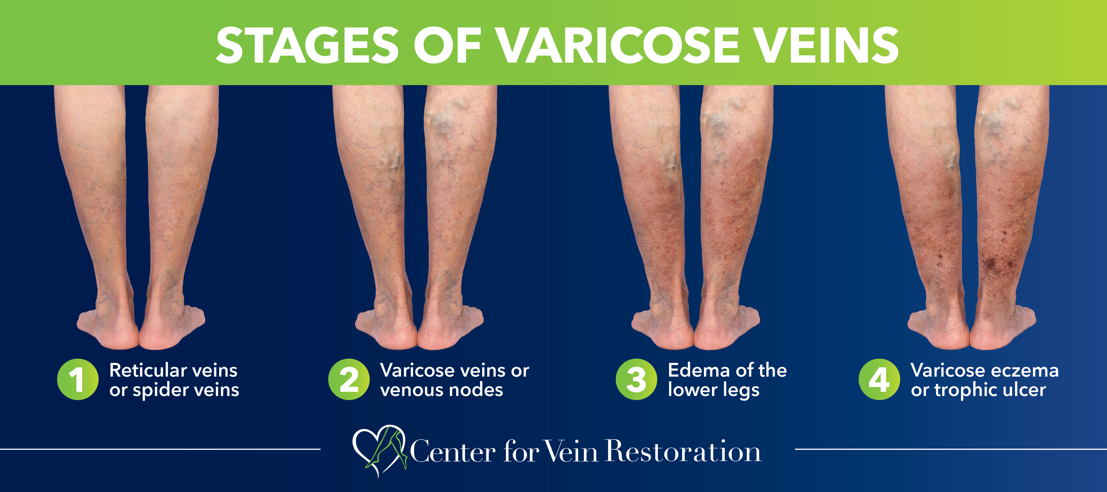 When To Worry About Varicose Veins