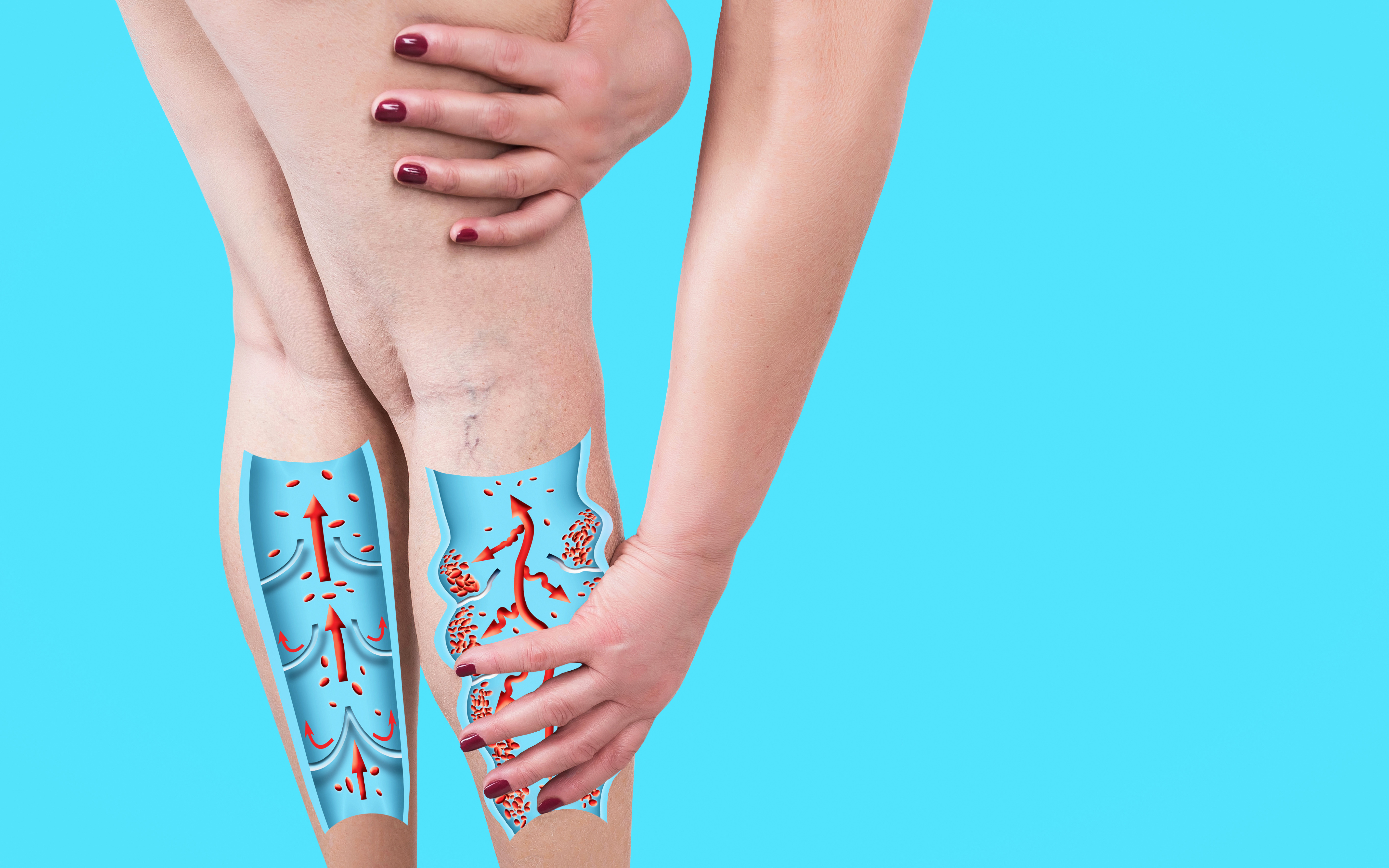 How to Get Rid of Spider Veins and Varicose Veins  SELF