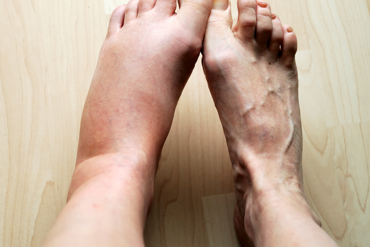 swollen ankles Archives - Relieve Foot Pain & Leg Pain