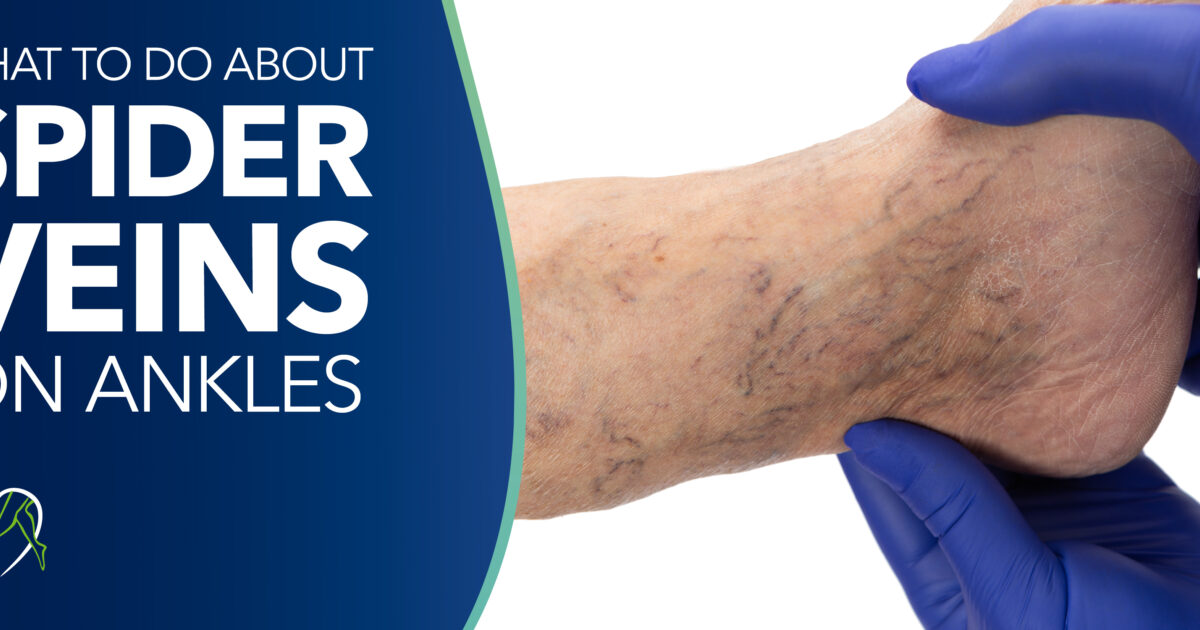 Spider Veins on Ankles - Vein Solutions