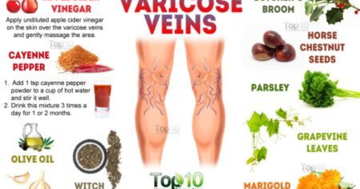 Home Remedies For Varicose Veins