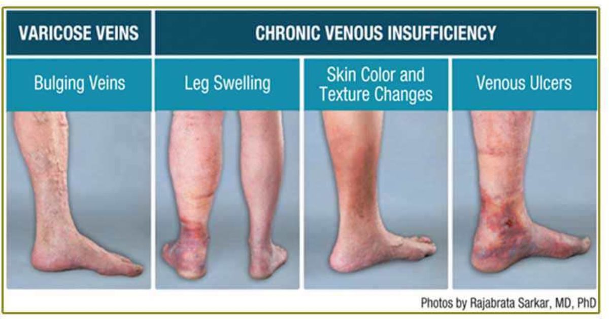 Venous insufficiency is a disease process which can affect all age groups.