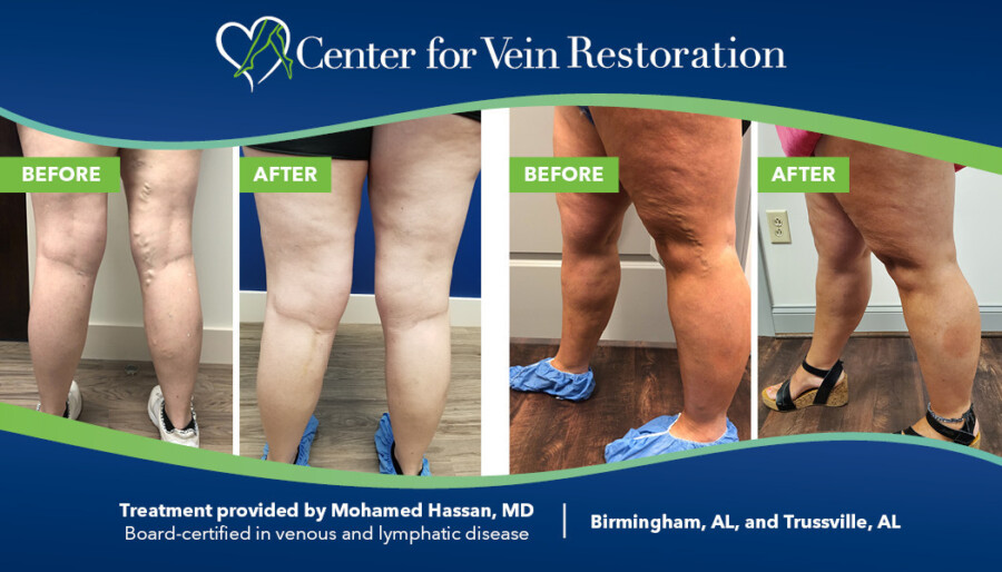 A Closer Look at Chronic Venous Insufficiency: Understanding Symptoms and  Treatments