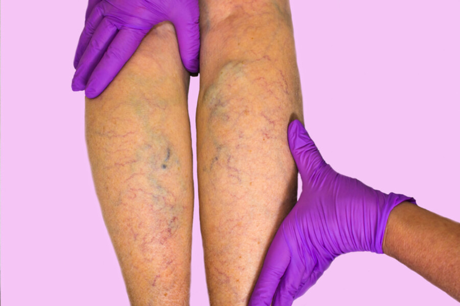Learning the Difference Between Chronic Venous Insufficiency and
