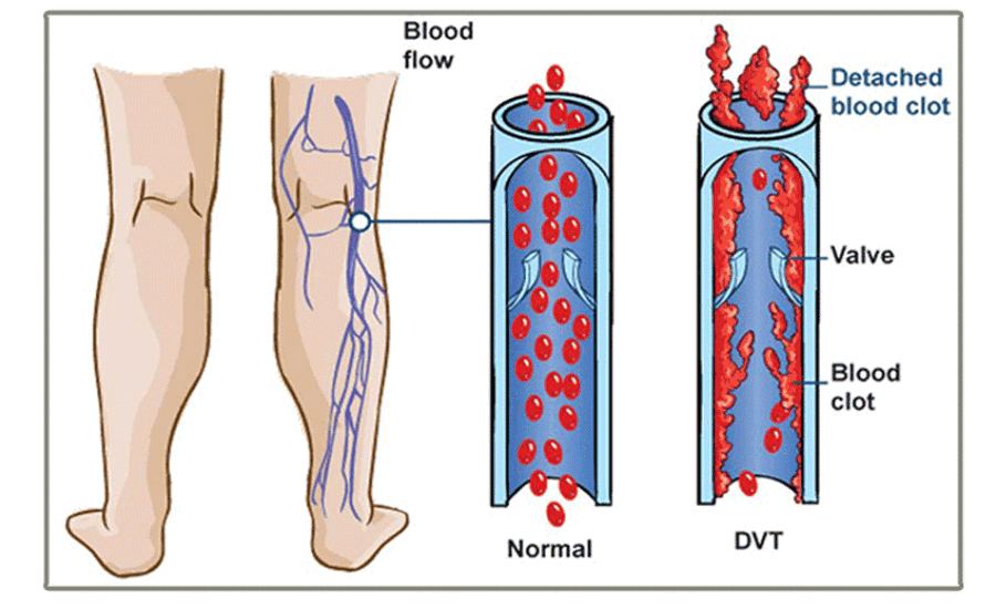 The Danger of DVT (Deep Vein Thrombosis)
