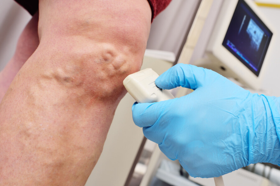 The Complete Guide to Varicose Vein Treatment