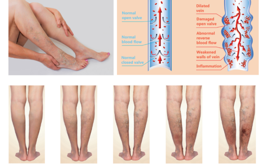 Las piernas cansadas, entre los síntomas más habituales de la insuficiencia  venosa crónica