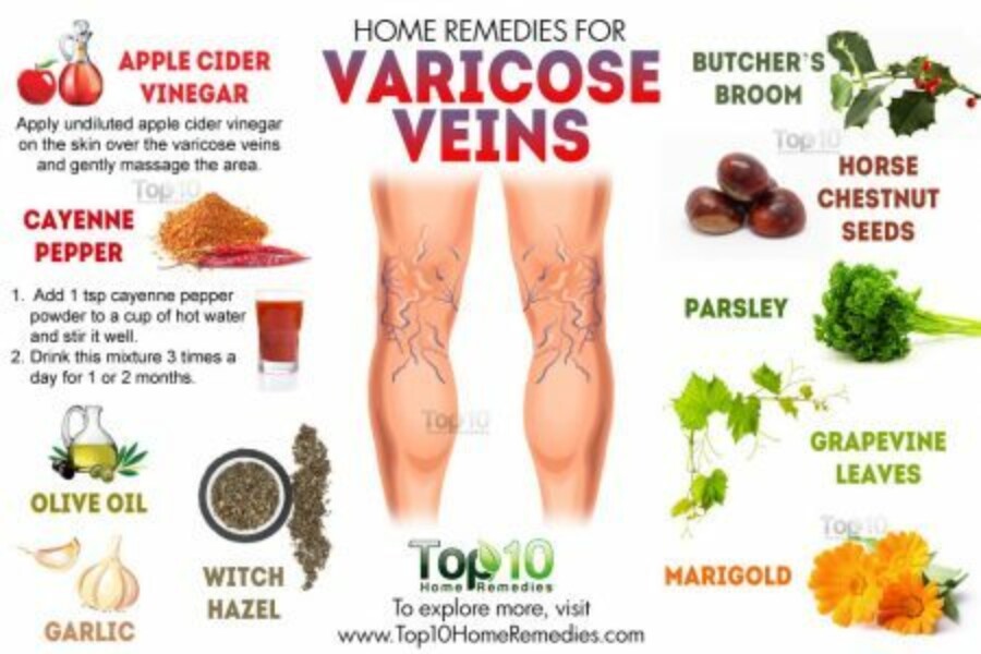 Los 11 mejores remedios para tratar las varices - Mejor con Salud