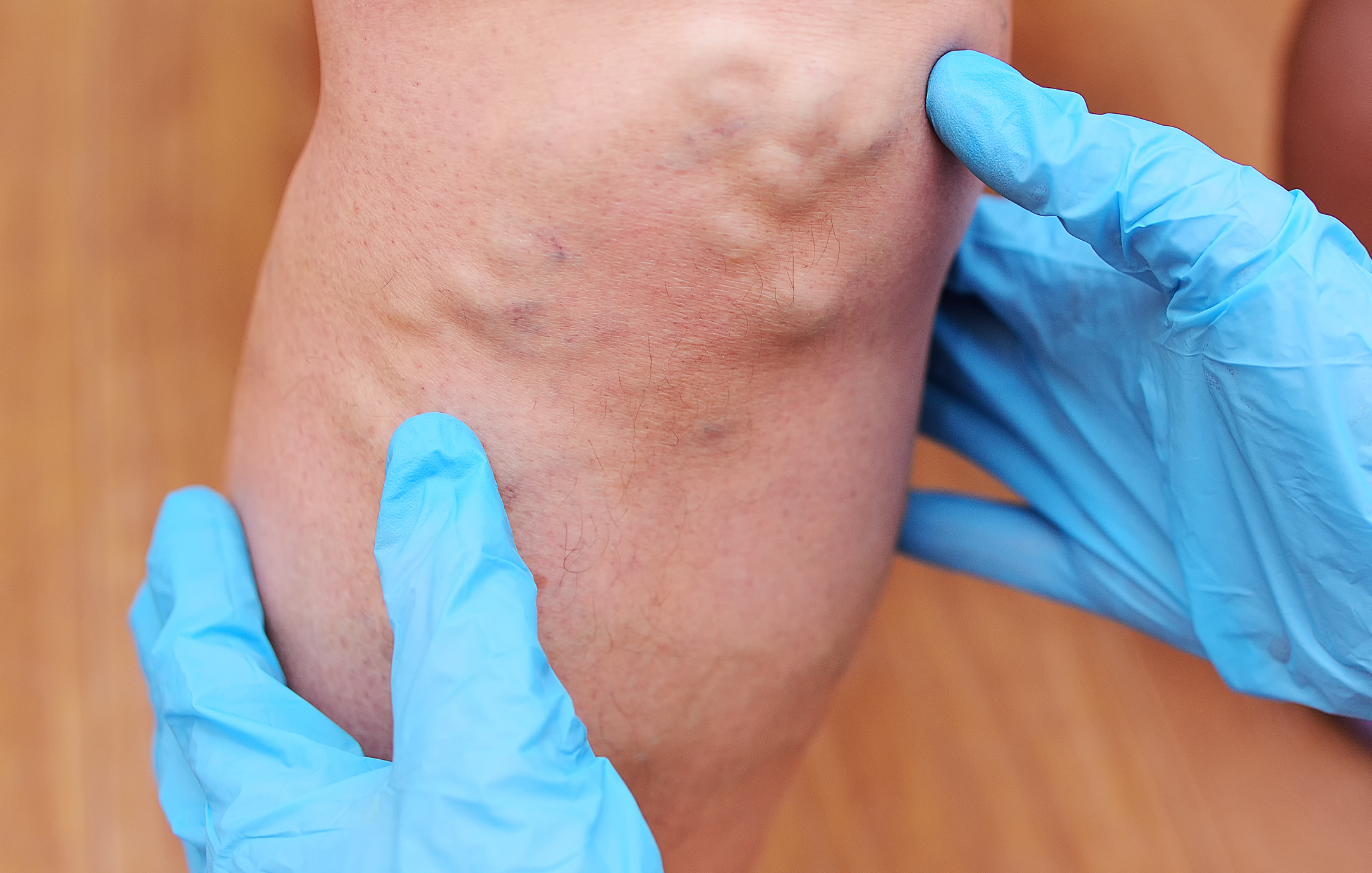 deep vein thrombosis in thigh