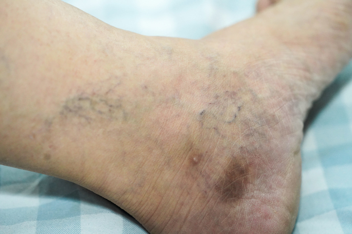 tinción cuscús Hundimiento Center for Vein Restoration | ¿Cuáles son esas manchas marrones en mis  piernas?