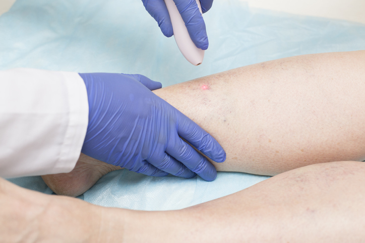 Don't Let Fear Stop You From Getting Varicose Vein Surgery