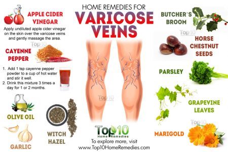 How to Treat Painful Varicose Veins at Home with Compression
